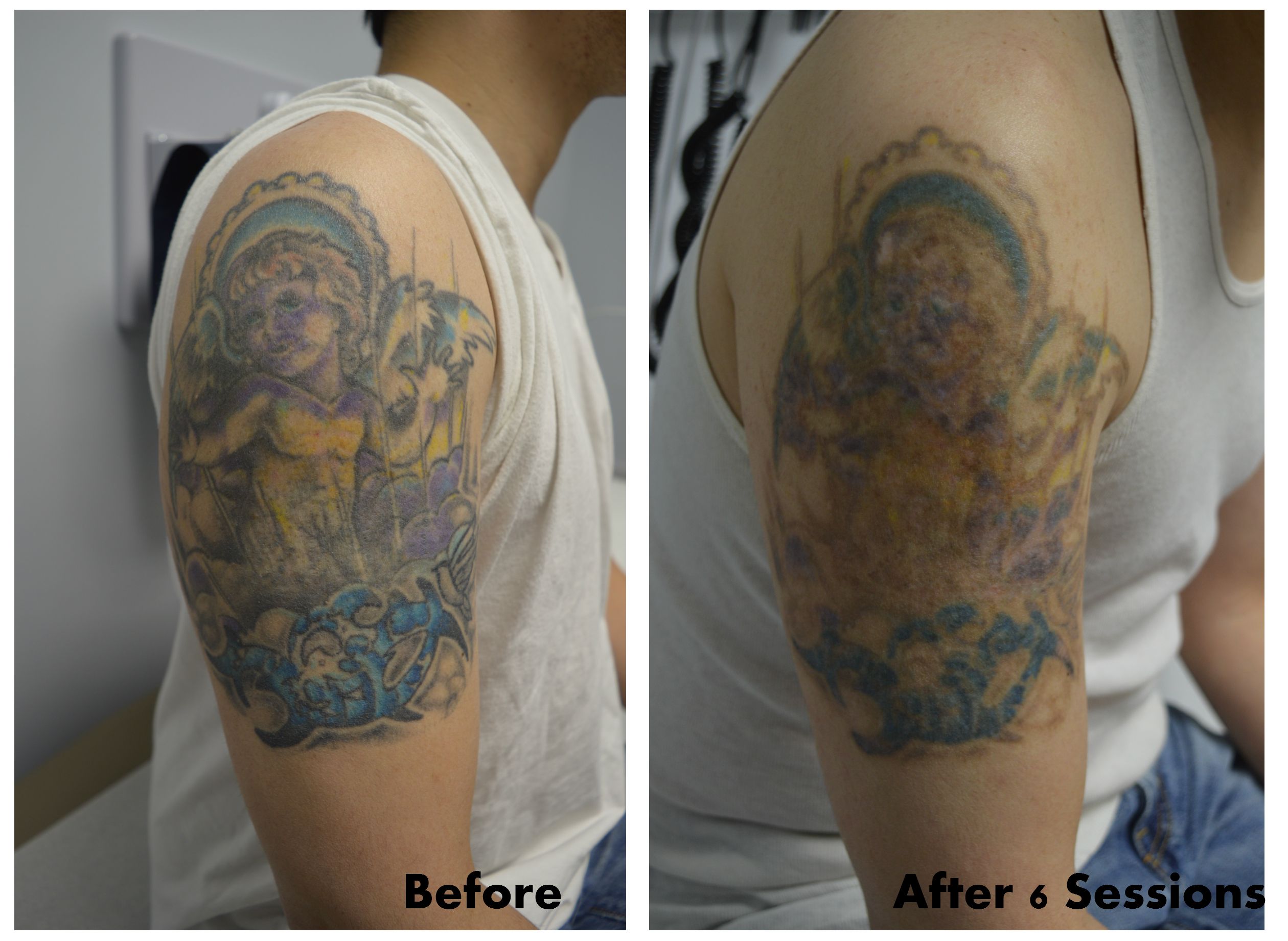 Color Sleeve Tattoo Removal
