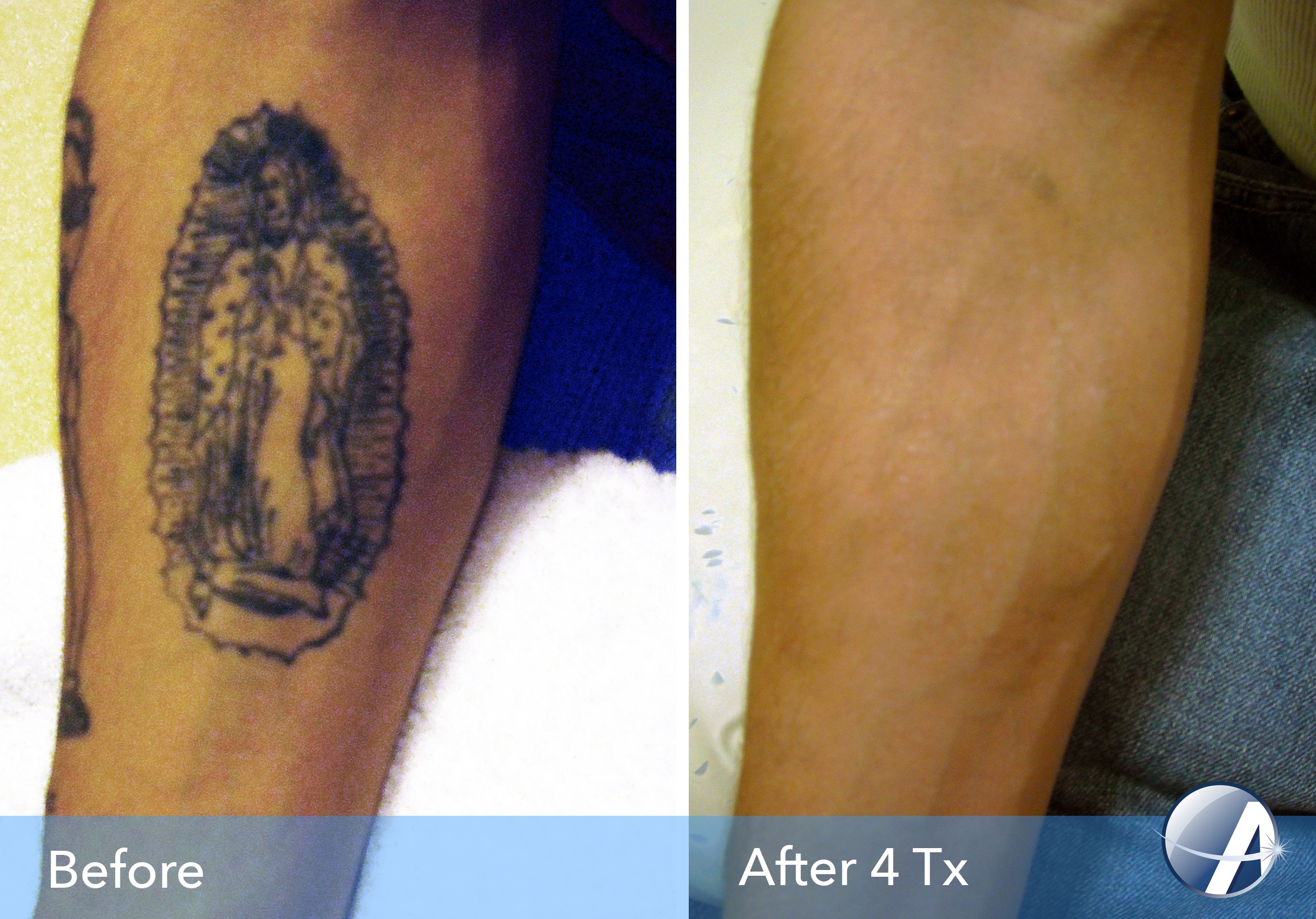 Dark Tattoo Removal Before And After
