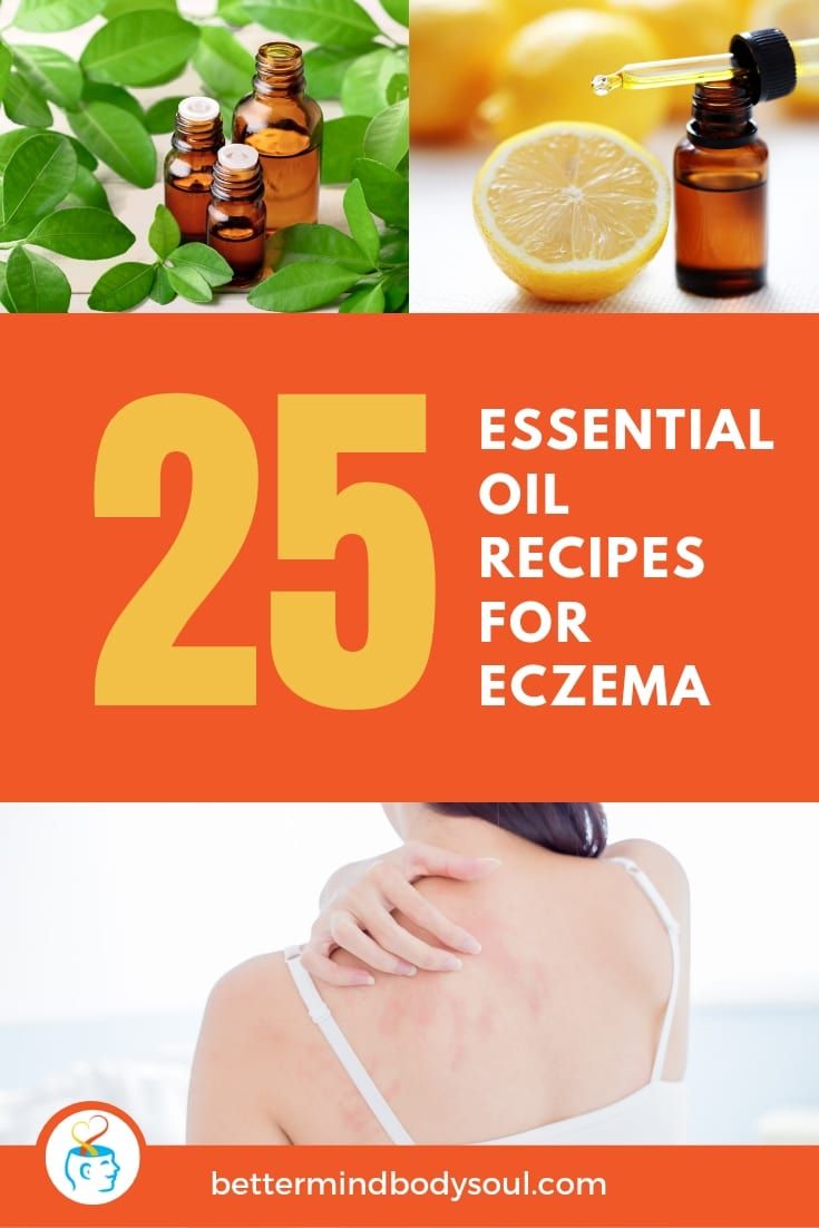 Diy Essential Oil Blend For Eczema