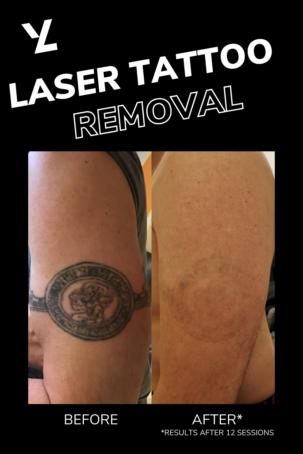 How Many Laser Tattoo Removal Sessions Are Needed