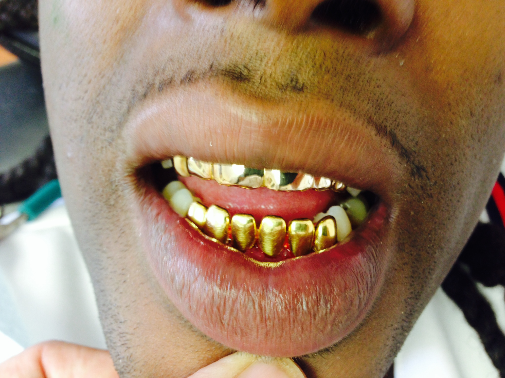 How Much For Permanent Gold Teeth