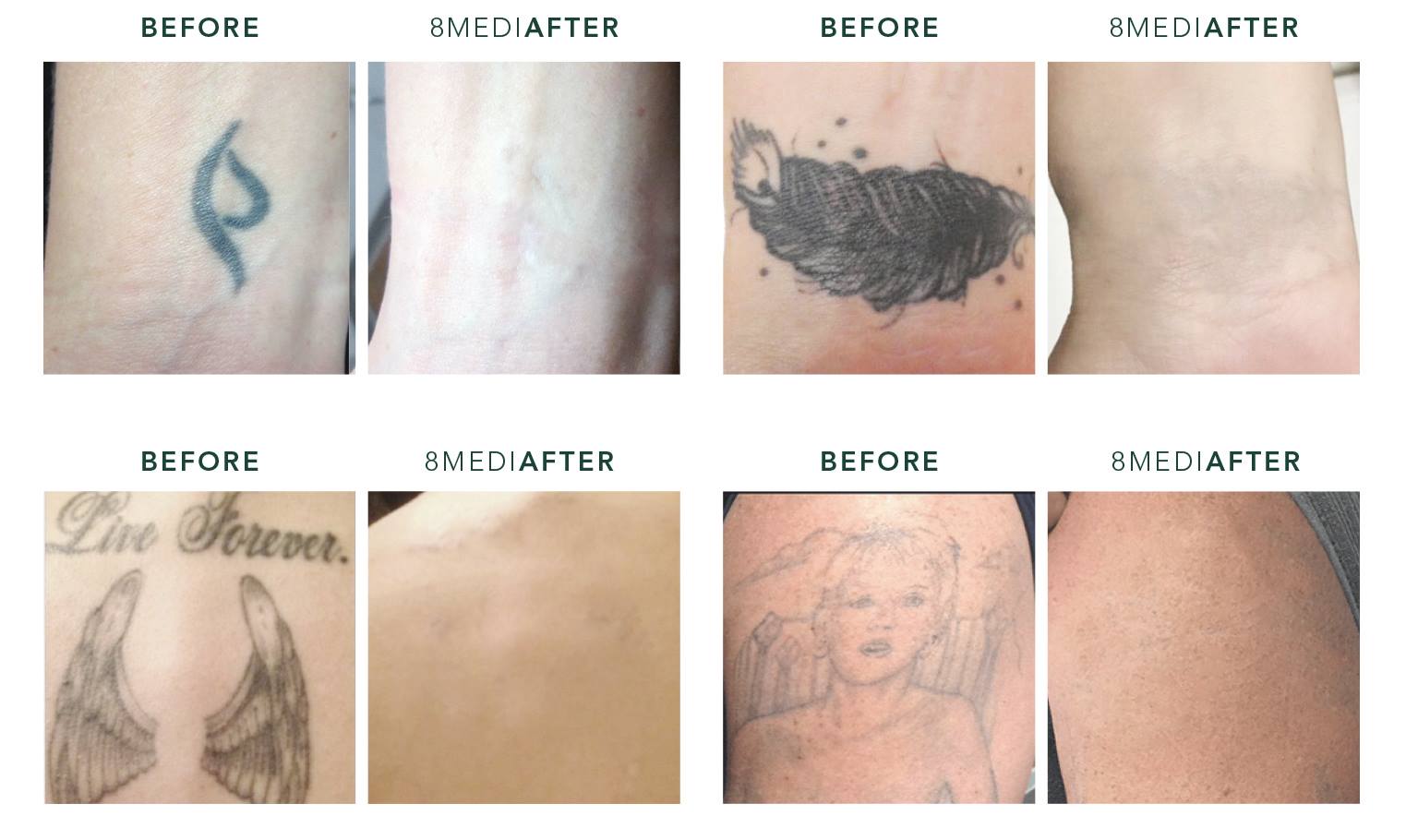 How Much Is Surgical Tattoo Removal