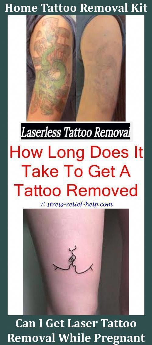 How Much Tattoo Removal Cost