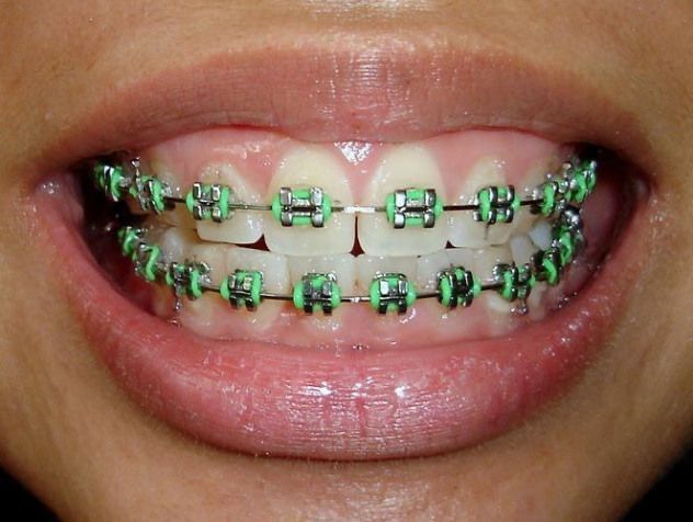 How To Put Fake Braces On Your Teeth