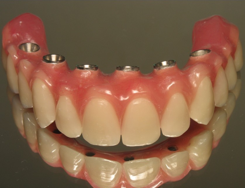 Prothese Dentaire Fixe Sur Implant