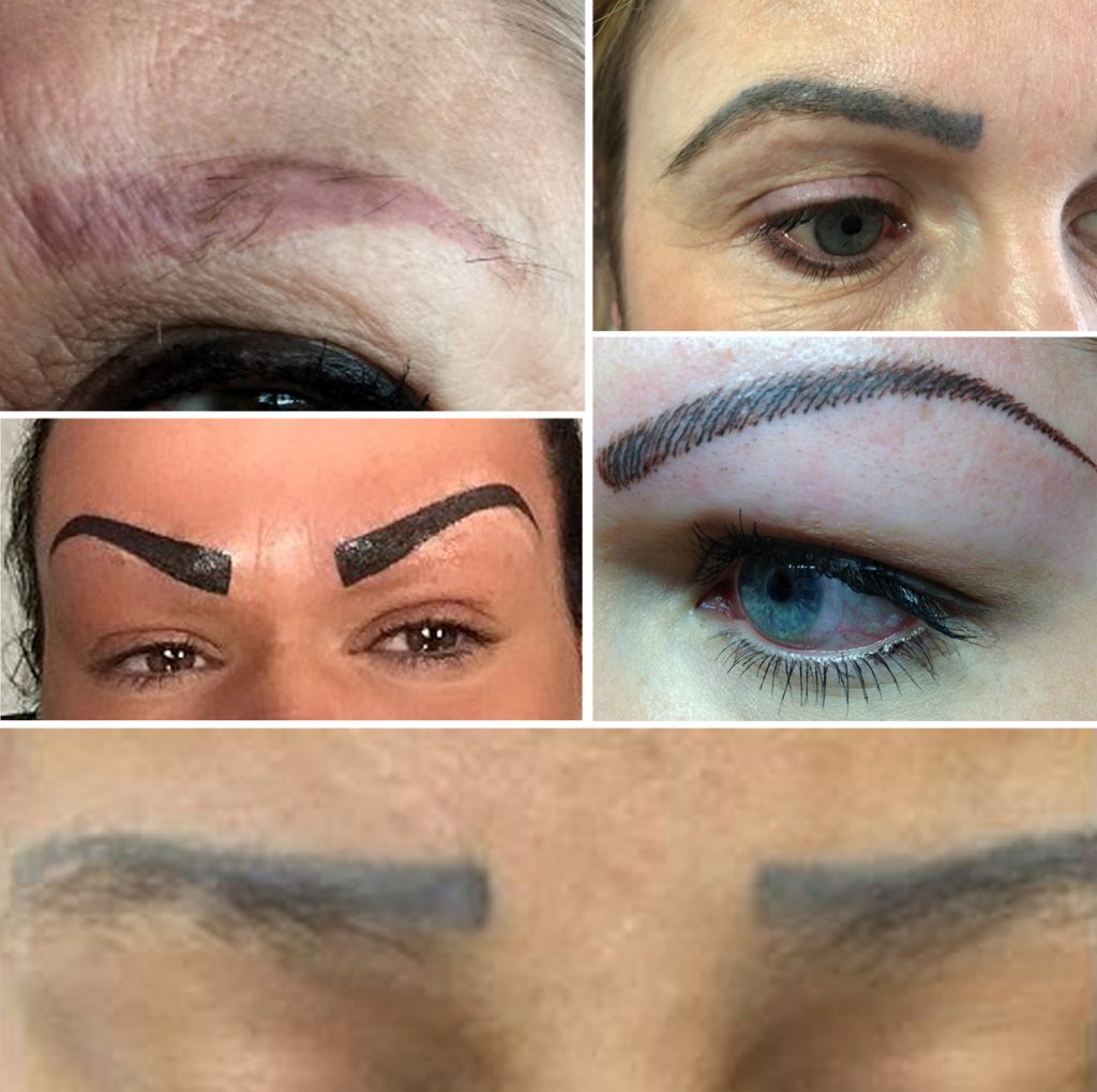 Remove Tattoo From Eyebrow