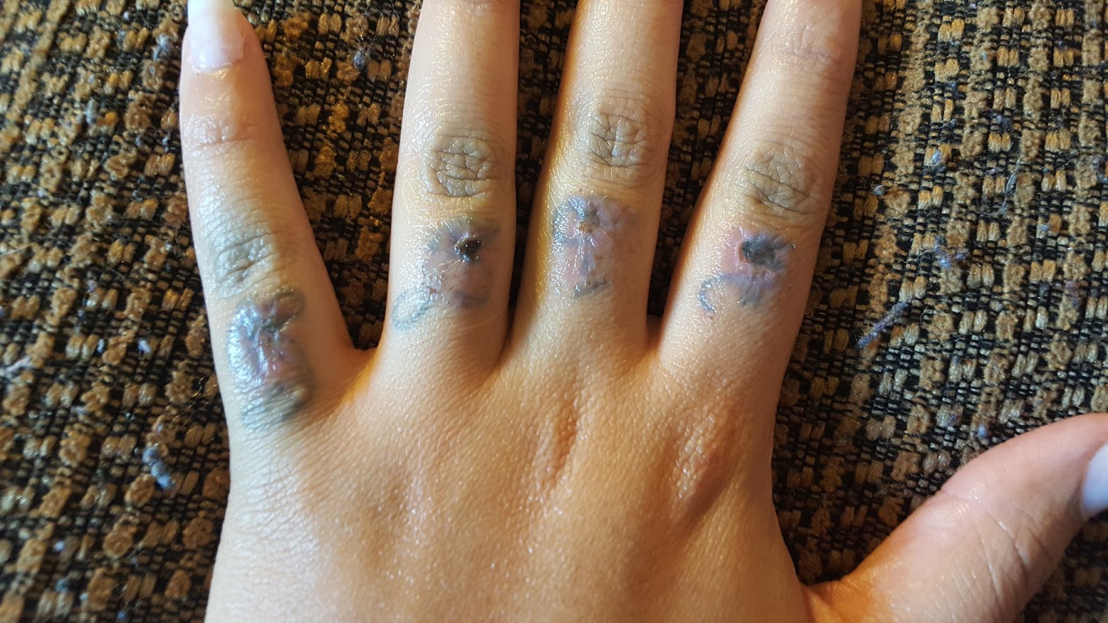 Salabrasion Tattoo Removal Before And After