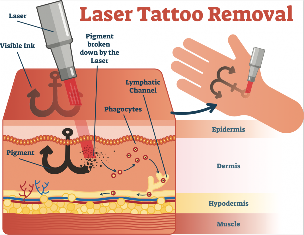 Tattoo Removal Types Of Laser